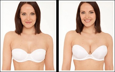 Before and after breast lift procedure