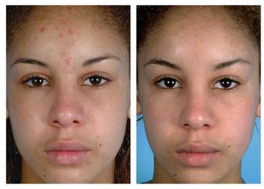 Microdermabrasion procedure
