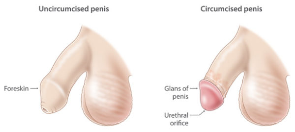 Baby circumcision procedure