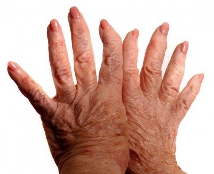Carpal Tunnel procedure