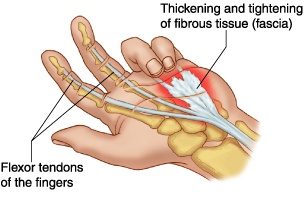Dupuytren's Contracture procedure