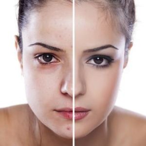 Before and after laser therapy