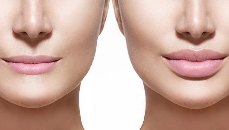 Before and after facial fillers