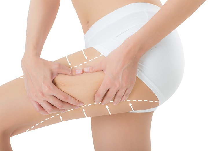 Thigh Lift procedure